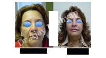 वसा स्थानांतरण / वसा ग्राफ्टिंग - Facial Liposculpture