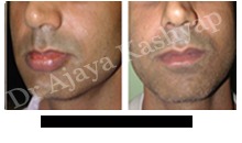 लिप रेजुवेनेशन