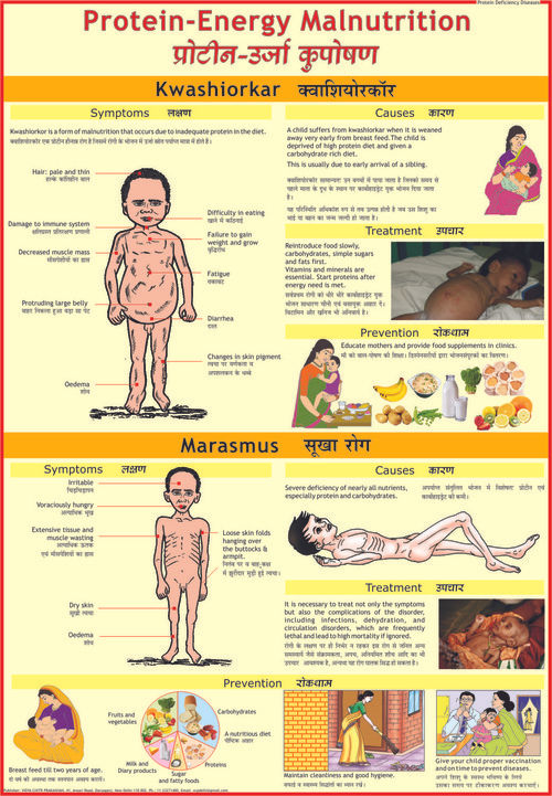 प्रोटीन ऊर्जा कुपोषण (क्वाशिओरकर और मरास्मस) चार्ट आयाम: 70 X 100 सेंटीमीटर (Cm)