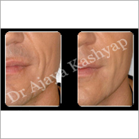 गाल इम्प्लांट सर्जरी