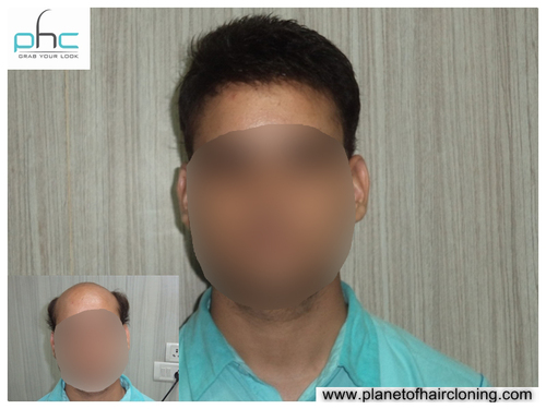 Non-Surgical Hair Bonding - Advanced Hair Replacement Technique | Instant Results, Zero Side Effects, Painless and Undetectable Solution