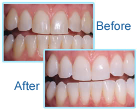 Laser Teeth Whitening in One Hour
