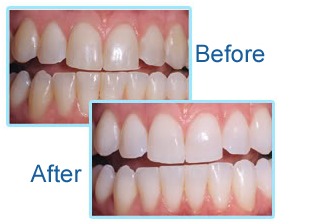 Laser Teeth Whitening In One Hour
