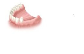 कई लापता दांतों के लिए दंत प्रत्यारोपण