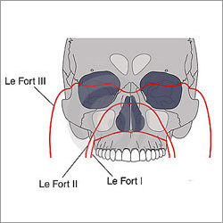 मैक्सिलो फेशियल फ्रैक्चर