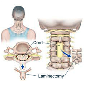 लैमिनोटॉमी स्पाइन सर्जरी