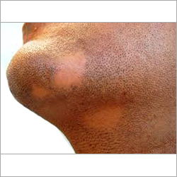 होम्योपैथिक उपाय अलोपेशिया एरेटा