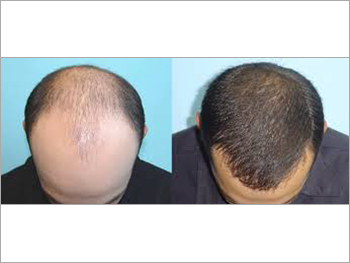 हेयर ट्रांसप्लांट सर्जरी