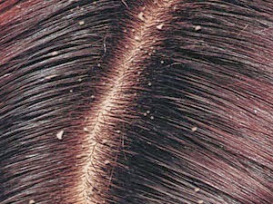 होम्योपैथिक डैंड्रफ उपचार