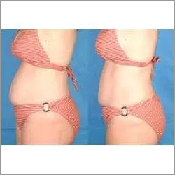 Body Slimming Devic
