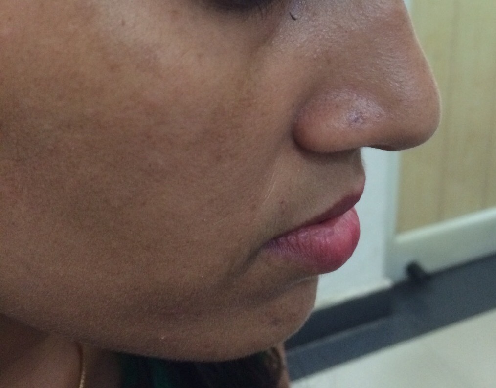 Mole Removal Treatment
