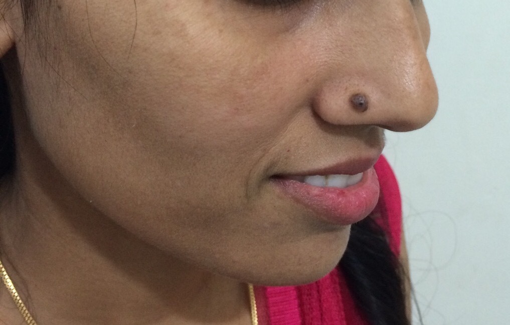 Mole Removal Treatment