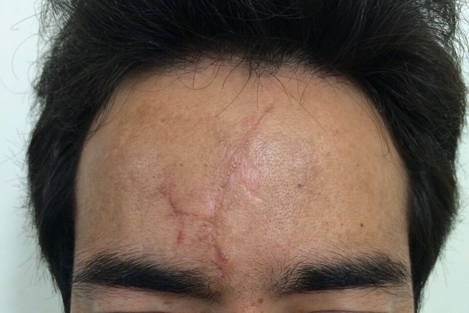 Fractional Erbium Laser Services