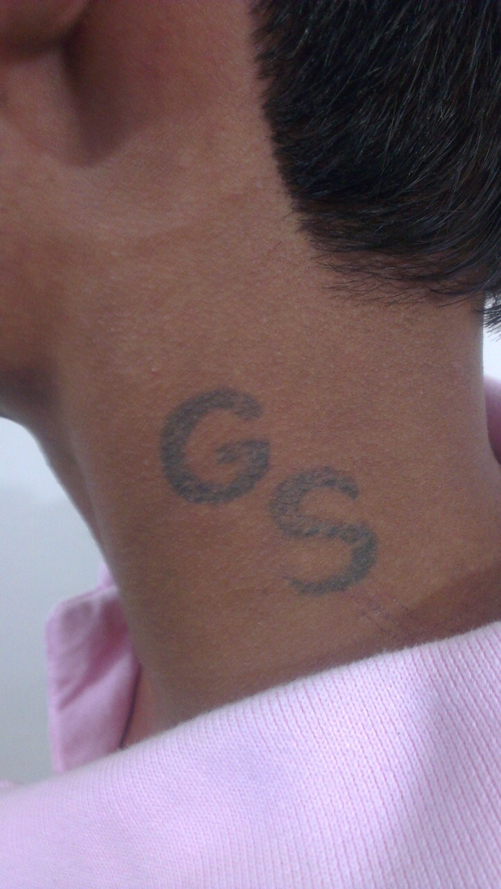 Laser Tattoo Removal Services