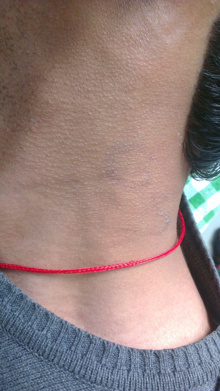 Laser Tattoo Removal Services