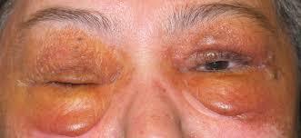 एमाइलॉइडोसिस