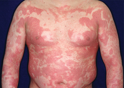 Psoriasis Ayurvedic Medicine Age Group: Suitable For All