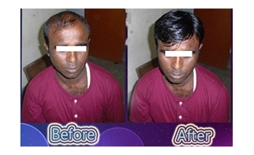 Hair Fall Solution