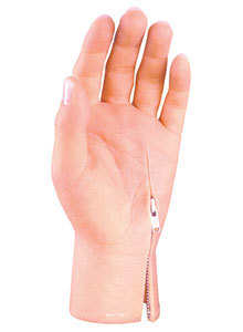 आंशिक हाथ प्रॉस्थेसिस