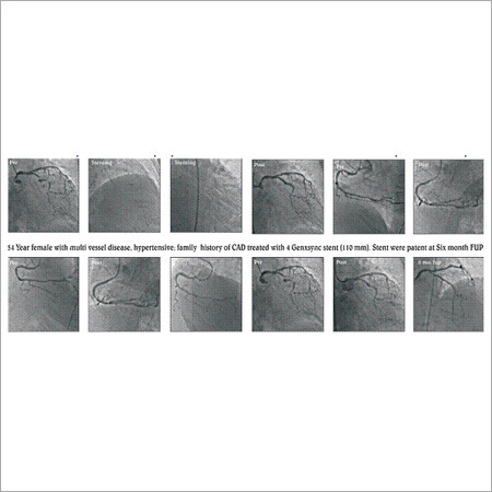 GenXsync Stent