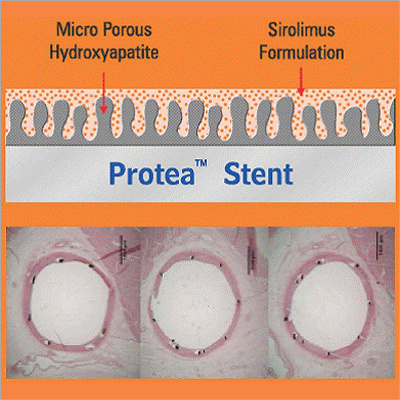 Sirolimus Eluting Stent