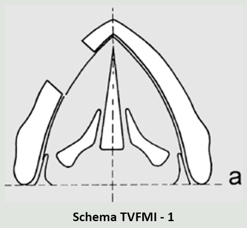 थायरोप्लास्टी