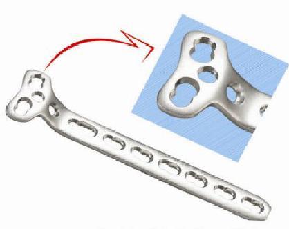 5.0 मिमी स्क्रू के लिए लॉकिंग टी बट्रेस प्लेट