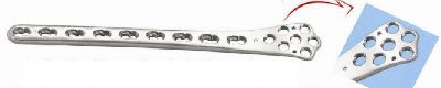 Locking Distal Femoral Plate For 5.0mm Screws