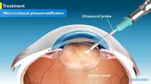 Phacoemulsification
