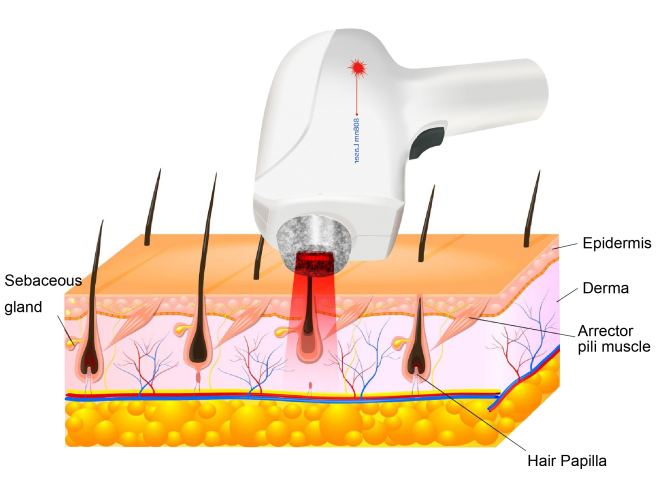 808nm Laser Hair Removal Machine