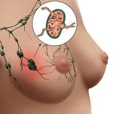 Breast Cancer Chemo-therapy Treatment