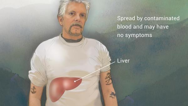 Hepatitis A, B, C, D & E Non Invasive Diagnosis & Treatment