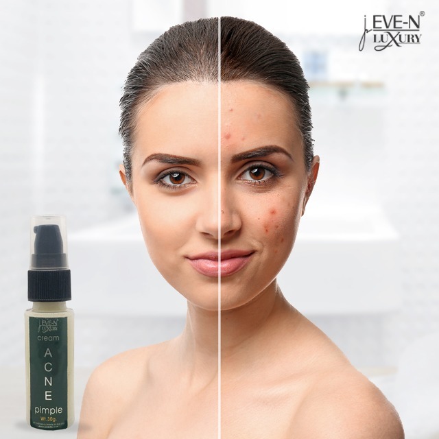 Eve-n Luxury Cream Acne 30g Age Group: Women
