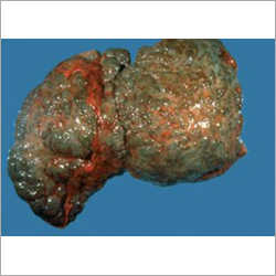 Cirrhosis Herbal Drops Recommended For: All
