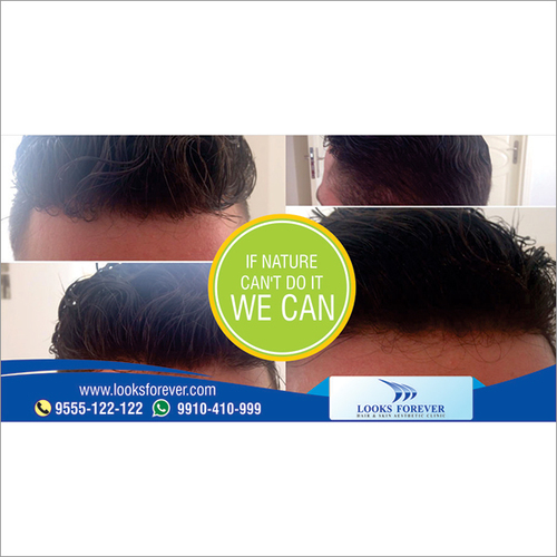 Mena  s Hair Replacement