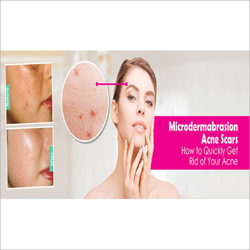 Microdermabrasion Treatment