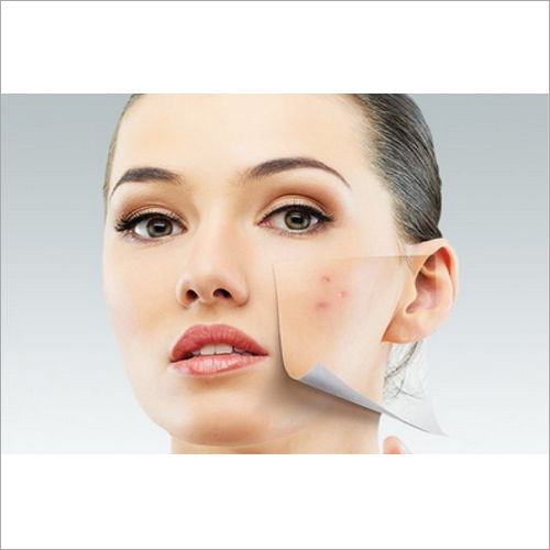 Acne Scar Removal
