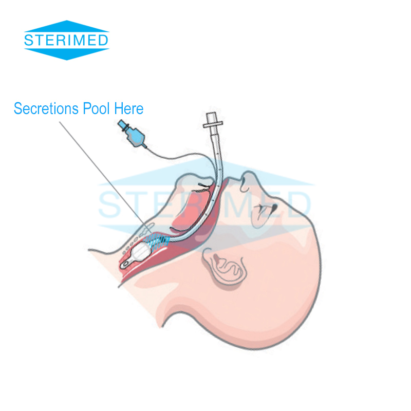 Transparent Endotracheal Tube With Subglottic Suction