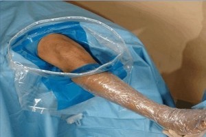 Arthroscopy Drape - Disposable, Level 4 Protection, Fluid Resistant Design | Enhanced Post Operative Healing, Minimal Pain & Infection Risk