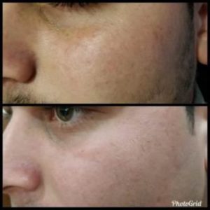 Powder Glutathione Injection