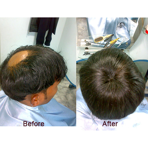 Hair Transplant