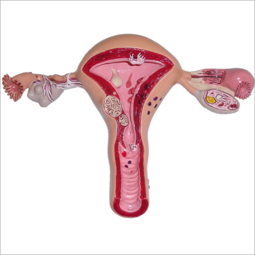 Pathological Uterus Model