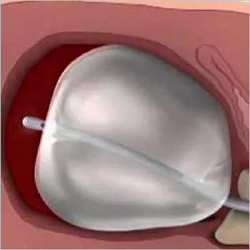 बकरी बैलून