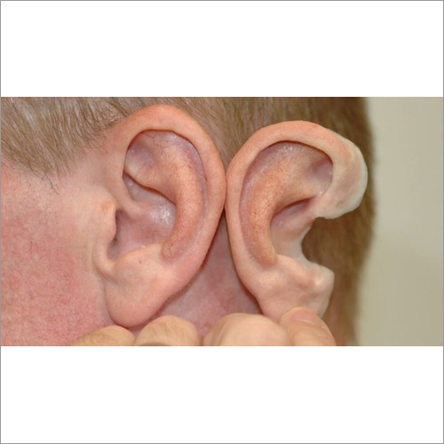 Silicone Ear Prosthesis - Realistic Design for Microtia Patients , Customizable Shape and Size for Enhanced Comfort