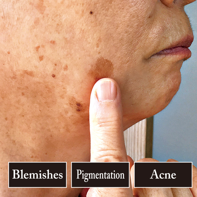 Humanano Placen Concentrated Serum White Age Group: All Age Group