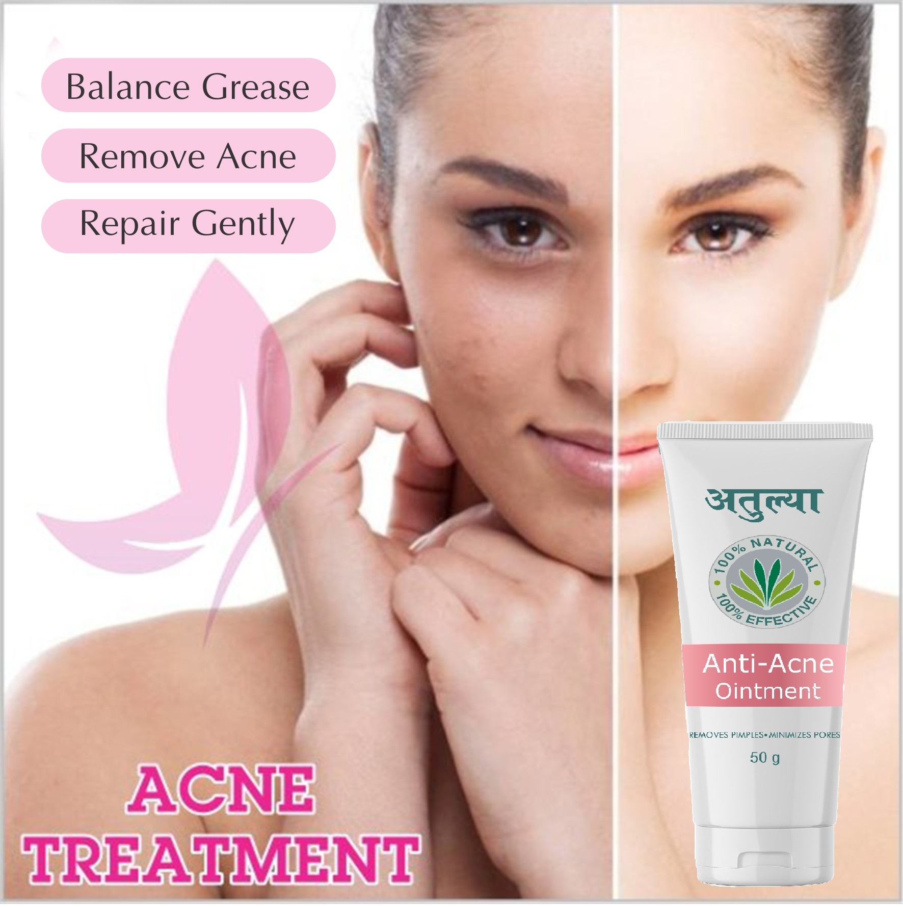 50gm Remove Pimple Minimizes Pores Ointment
