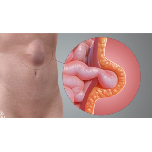 Hernia Surgery Service
