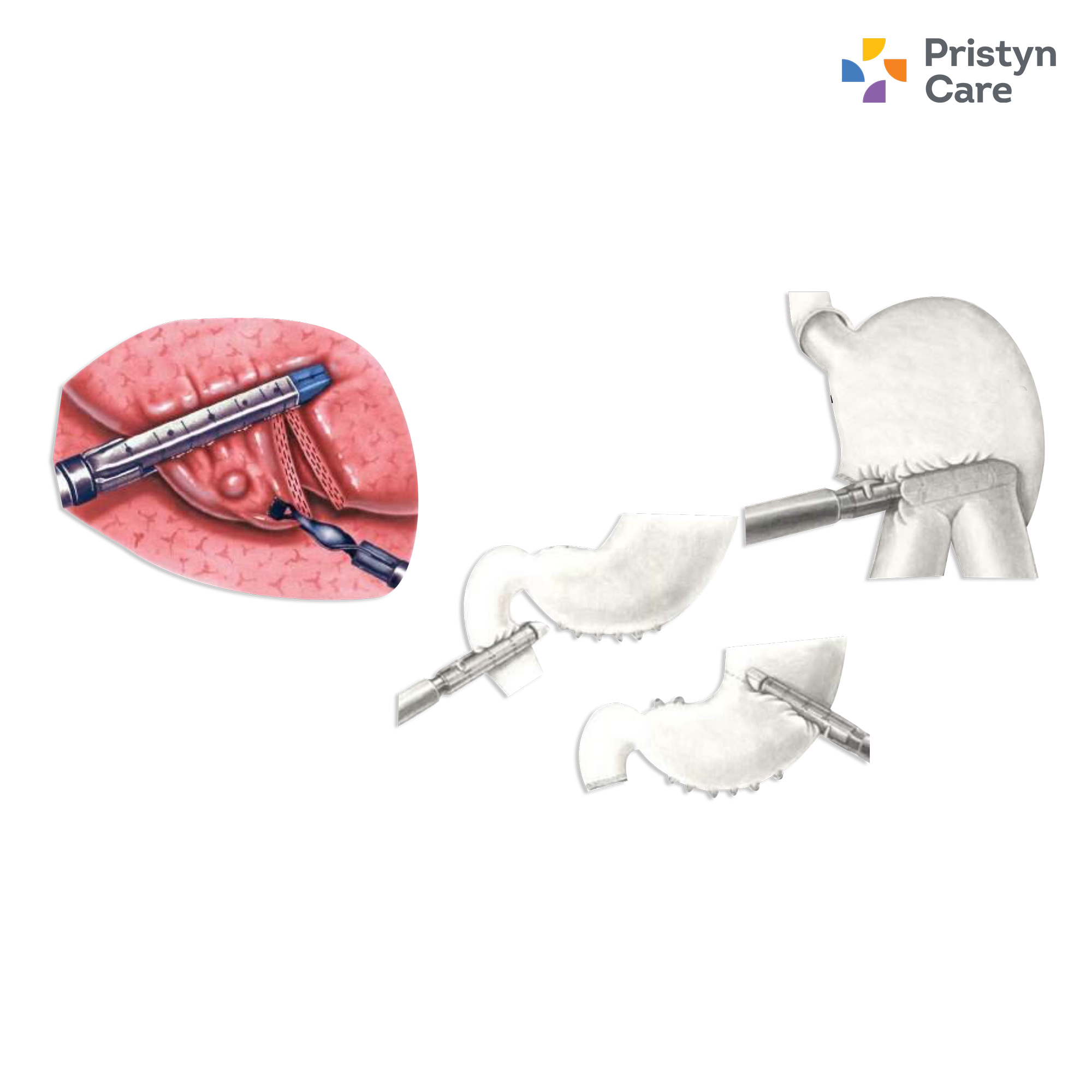 Reach Endo Src 6035r Loader (Sulu)