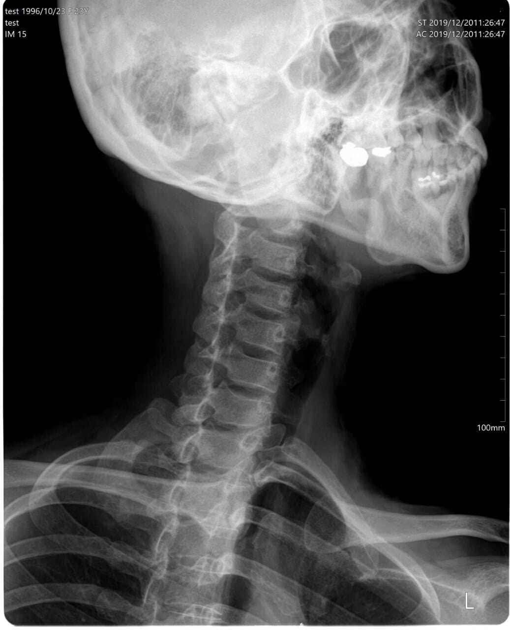 Computed Radiography Color Code: Whire