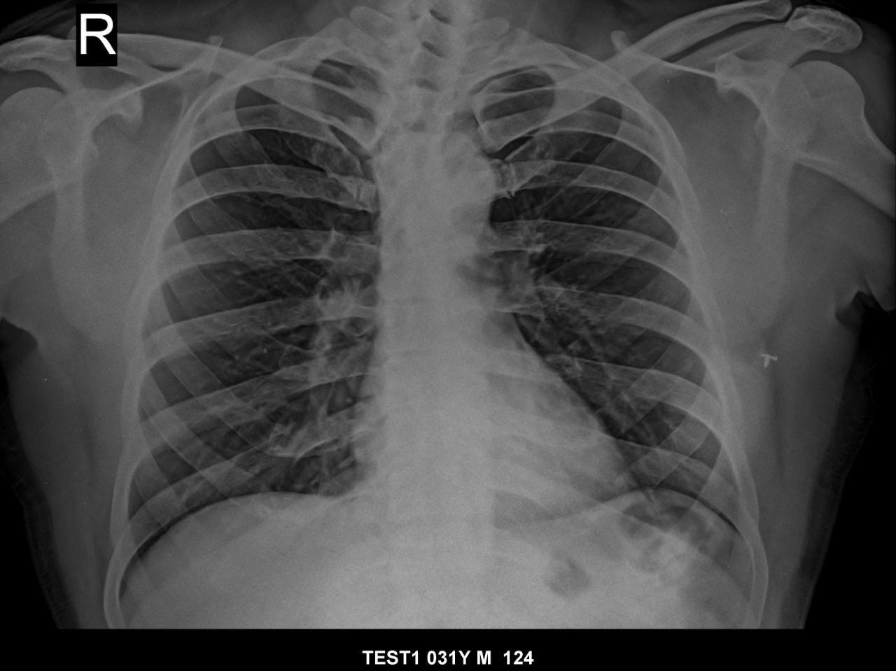 Computed Radiography Color Code: Whire